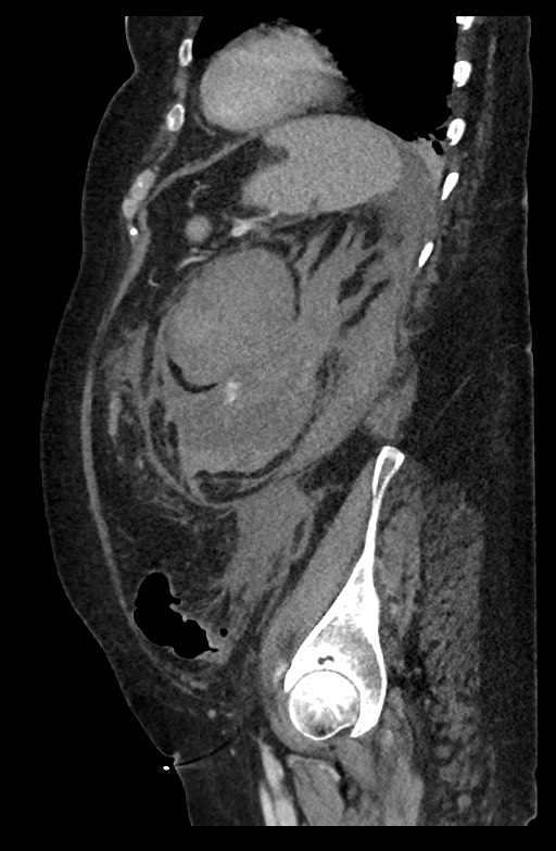 Active renal extravasation with large subcapsular and retroperitoneal hemorrhage (Radiopaedia 60975-68796 Sagittal C+ portal venous phase 72).jpg