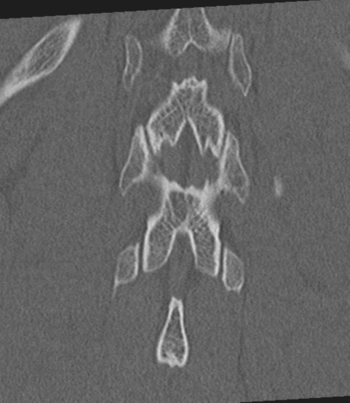 Acute L1 burst compression fracture (Radiopaedia 34430-35755 Coronal bone window 48).png