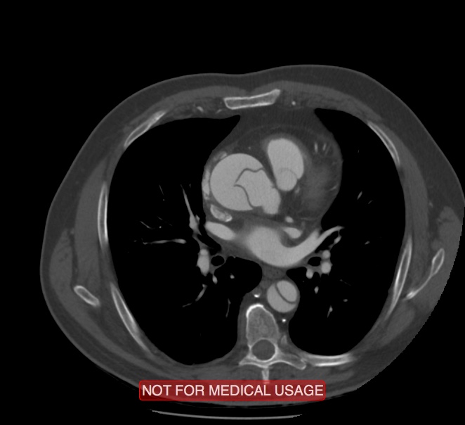 Acute aortic dissection - Stanford type A (Radiopaedia 40661-43285 Axial C+ arterial phase 33).jpg