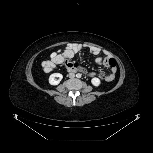 File:Acute appendicitis, heterotaxy syndrome (Radiopaedia 66884-76202 Axial 15).jpg