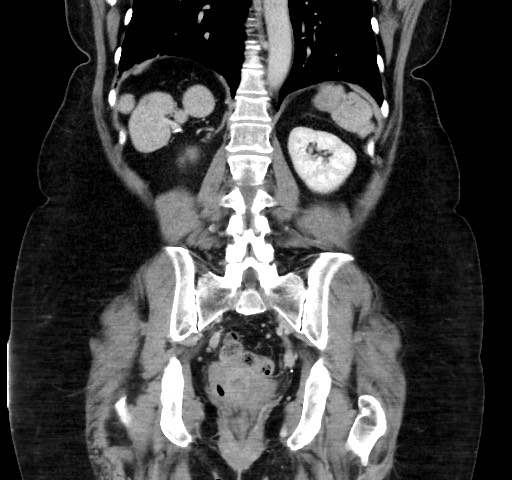 Acute appendicitis, heterotaxy syndrome (Radiopaedia 66884-76202 Coronal C+ portal venous phase 88).jpg
