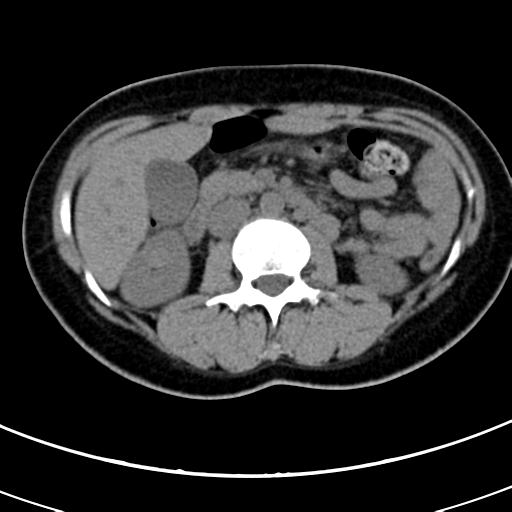 Acute appendicitis (Radiopaedia 30261-30888 Axial non-contrast 29).jpg