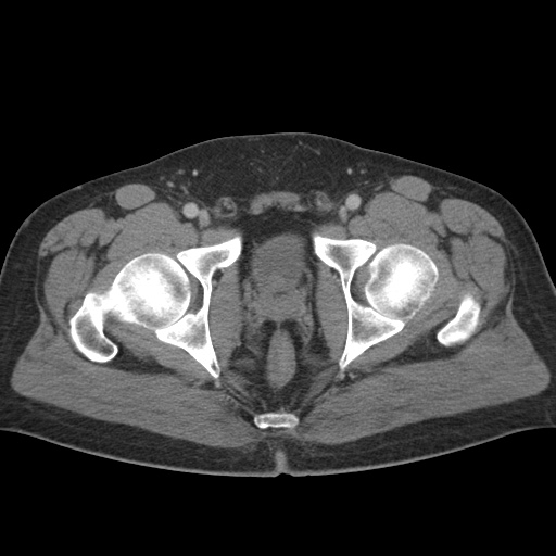 Acute appendicitis (Radiopaedia 48511-53463 Axial C+ portal venous phase 99).jpg