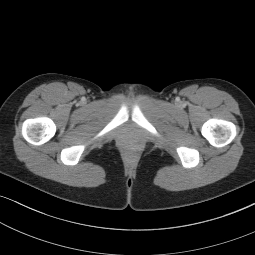 Acute appendicitis (Radiopaedia 62608-70901 Axial C+ portal venous phase 71).jpg