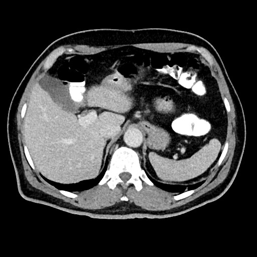 File:Acute appendicitis (Radiopaedia 77016-88960 Axial C+ portal venous phase 35).jpg