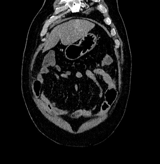 Acute appendicitis (Radiopaedia 79950-93224 Coronal C+ portal venous phase 13).jpg