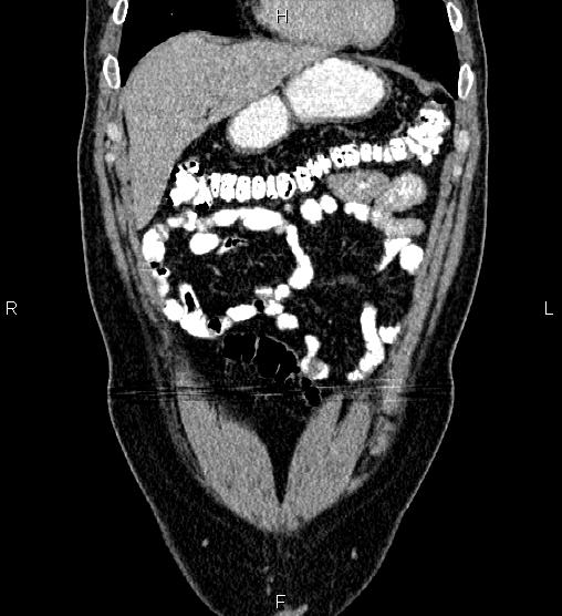 Acute appendicitis (Radiopaedia 84780-100240 Coronal C+ portal venous phase 16).jpg