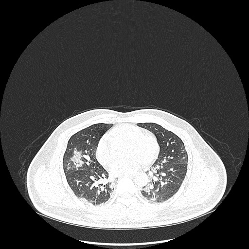 File:Acute appendicitis and COVID 19 pneumonia (Radiopaedia 76604-88380 Axial lung window 31).jpg
