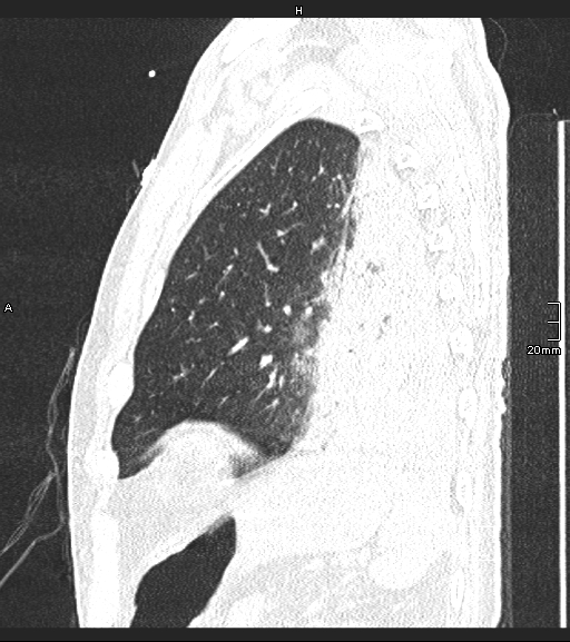 Acute aspiration pneumonitis (Radiopaedia 55642-62166 Sagittal lung window 26).jpg