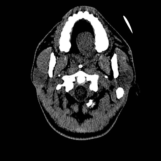 File:Acute basilar artery occlusion (Radiopaedia 43582-46985 Axial non-contrast 19).jpg