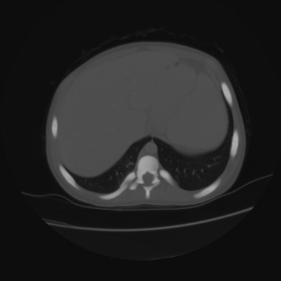 File:Acute calculous cholecystitis in patient with osteopetrosis (Radiopaedia 77871-90159 Axial bone window 8).jpg