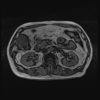 Acute cholecystitis (Radiopaedia 72392-82923 Axial T1 out-of-phase 62).jpg