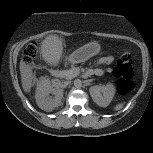 Acute cholecystitis and ureteric colic (Radiopaedia 42330-45444 Axial prone 33).jpg