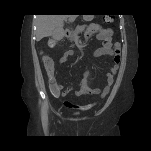 Acute cholecystitis with tensile fundus sign (Radiopaedia 71394-81723 Coronal non-contrast 55).jpg