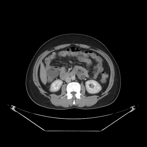 File:Acute complicated calculous cholecystitis (Radiopaedia 55202-61587 Axial C+ delayed 49).jpg