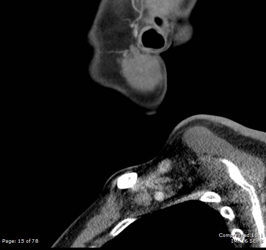 Acute epiglottitis (Radiopaedia 54375-60590 Sagittal C+ arterial phase 15).jpg