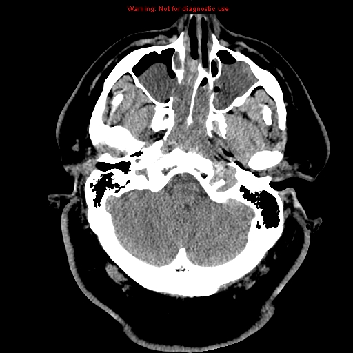 File:Acute hemorrhagic leukoencephalitis (Radiopaedia 14076-13920 Axial non-contrast 6).jpg