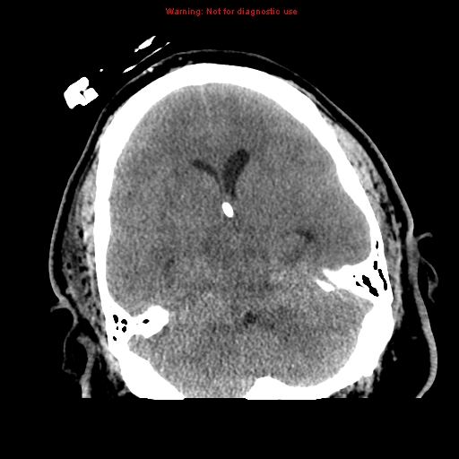 File:Acute hemorrhagic leukoencephalitis (Radiopaedia 14076-72275 Axial non-contrast 14).jpg
