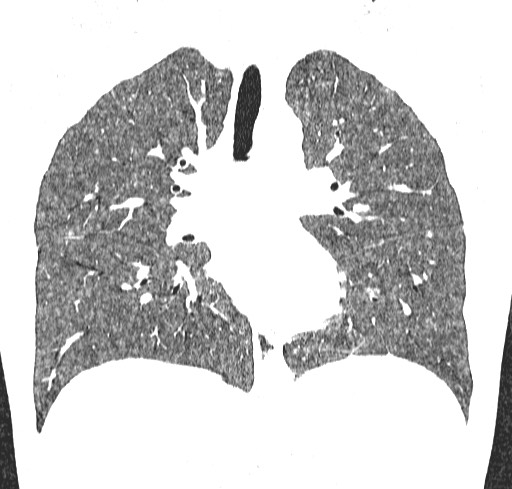 File:Acute hypersensitivity pneumonitis (Radiopaedia 85293-100870 Coronal lung window 66).jpg