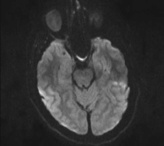 Acute ischemic stroke - posterior circulation territory (Radiopaedia 77670-89880 Axial DWI 32).jpg