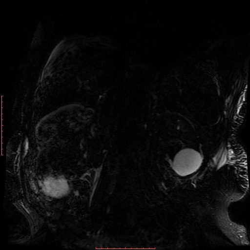 Acute necrotizing pancreatitis (Radiopaedia 28194-28448 Coronal MRCP 8).jpg