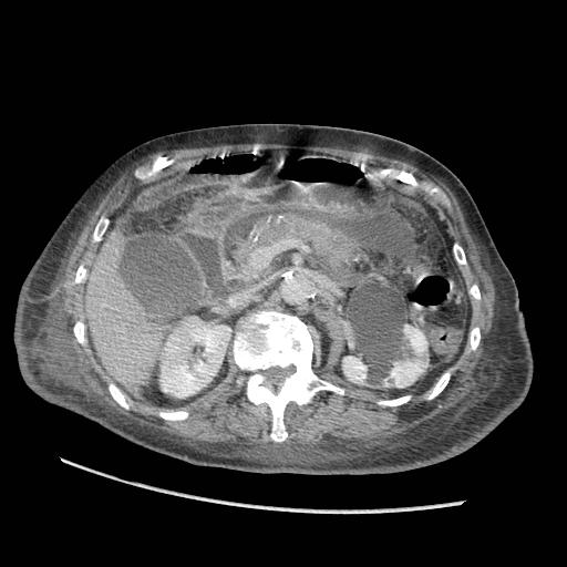 Acute on chronic pancreatitis (Radiopaedia 13233-13244 Axial C+ portal venous phase 38).jpg