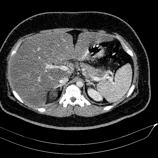 Acute on chronic pancreatitis (Radiopaedia 80902-94423 Axial C+ portal venous phase 44).jpg