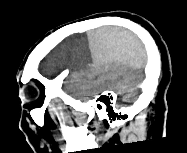 Acute on chronic subdural hematoma (Radiopaedia 78346-90966 Sagittal non-contrast 45).jpg