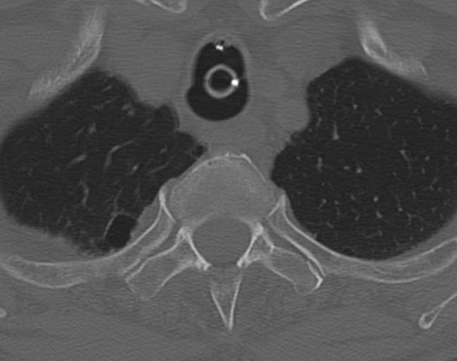 Acute on chronic subdural hematoma and thoracic vertebral injury in a multitrauma patient (Radiopaedia 31698-32619 Axial bone window 63).jpg