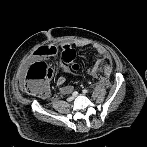 File:Acute pancreatic necrosis (Radiopaedia 13560-18501 Axial C+ portal venous phase 101).jpg