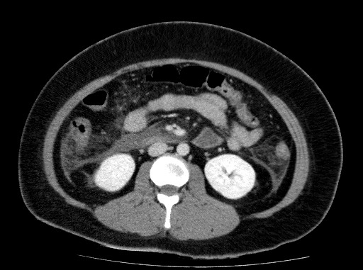 Acute pancreatitis (Radiopaedia 69236-79012 Axial C+ portal venous phase 46).jpg