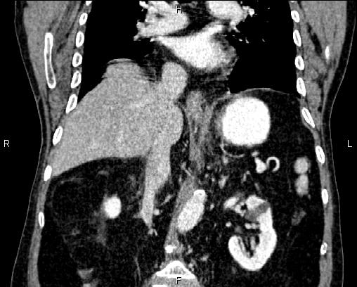 Acute pancreatitis (Radiopaedia 85146-100701 Coronal C+ portal venous phase 44).jpg