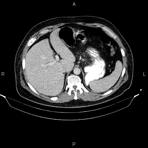 Acute pancreatitis (Radiopaedia 85390-101010 Axial C+ portal venous phase 23).jpg