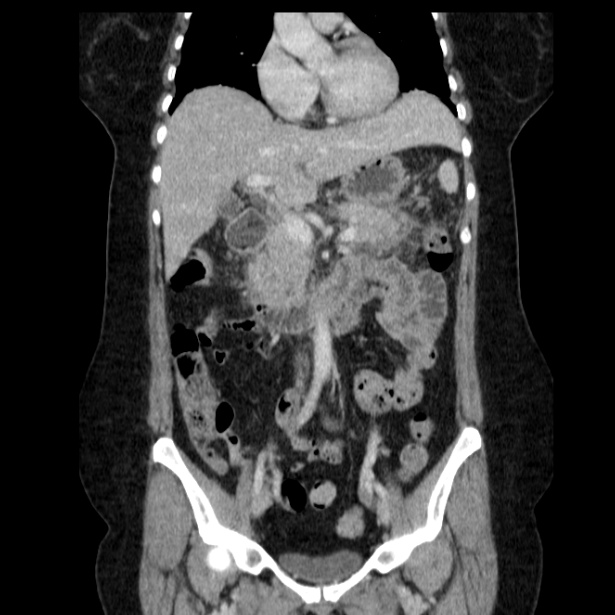Acute pancreatitis - Balthazar C (Radiopaedia 26569-26714 Coronal C+ portal venous phase 31).jpg