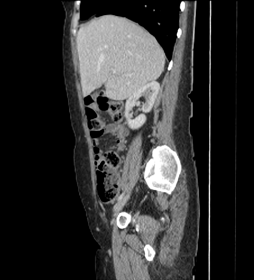 Acute pancreatitis - Balthazar E - post ERCP (Radiopaedia 27562-27772 Sagittal C+ portal venous phase 36).png