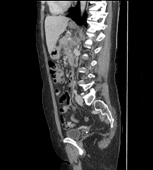 Acute pancreatitis - Balthazar E - post ERCP (Radiopaedia 27562-27772 Sagittal C+ portal venous phase 79).png