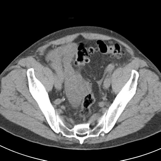 File:Acute pancreatitis and walled-off necrosis (Radiopaedia 29888-30403 Axial non-contrast 64).jpg