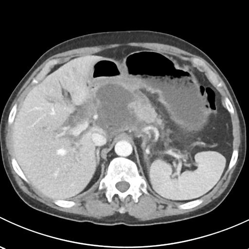 File:Acute pancreatitis and walled-off necrosis (Radiopaedia 29888-30404 Axial C+ portal venous phase 20).jpg