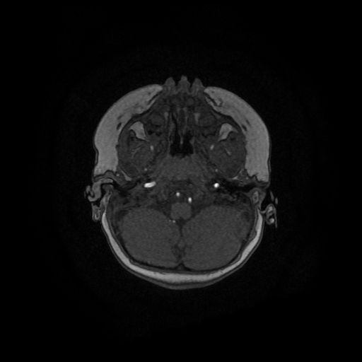 File:Acute phase of hemiconvulsion-hemiplegia epilepsy syndrome (Radiopaedia 29309-29745 Axial TOF angiography 133).jpg