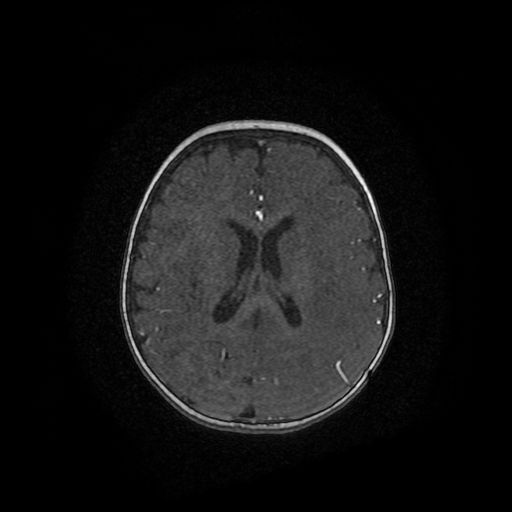 File:Acute phase of hemiconvulsion-hemiplegia epilepsy syndrome (Radiopaedia 29309-29745 Axial TOF angiography 28).jpg