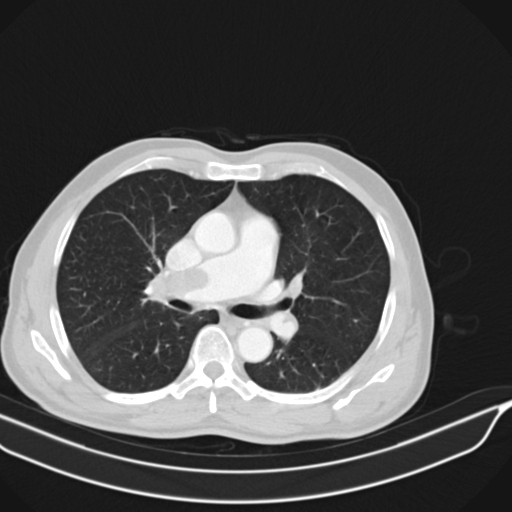 Acute pulmonary embolism (Radiopaedia 69510-79390 Axial lung window 6).jpg