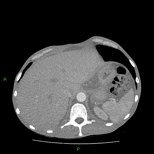 File:Acute right lung abscess (Radiopaedia 34806-36258 Axial C+ arterial phase 174).jpg
