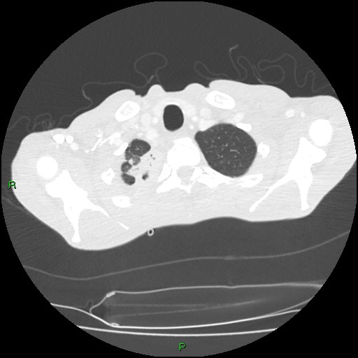 File:Acute right lung abscess (Radiopaedia 34806-36258 Axial lung window 14).jpg