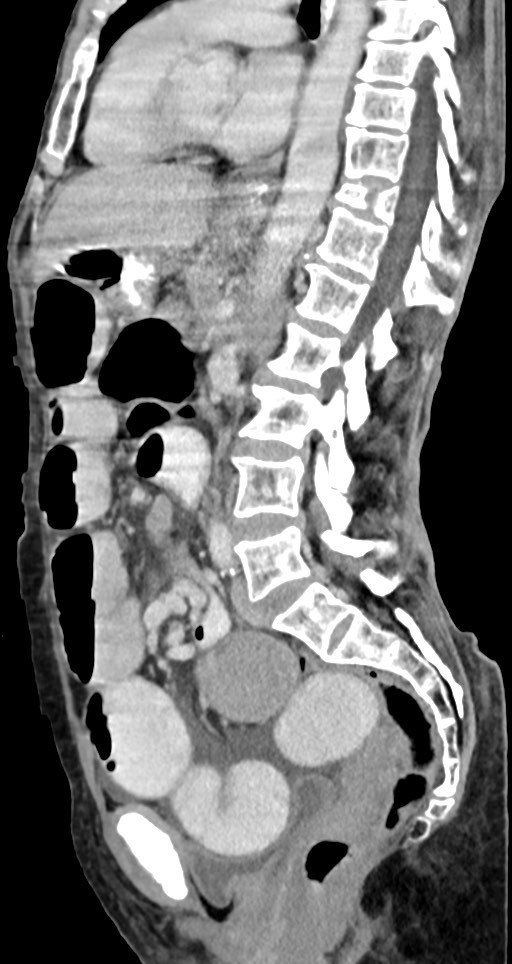 Acute small bowel (ileal) volvulus (Radiopaedia 71740-82139 Sagittal C+ portal venous phase 82).jpg