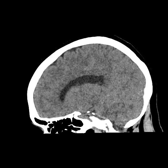 Acute subarachnoid hemorrhage and accessory anterior cerebral artery (Radiopaedia 69231-79008 Sagittal non-contrast 35).jpg