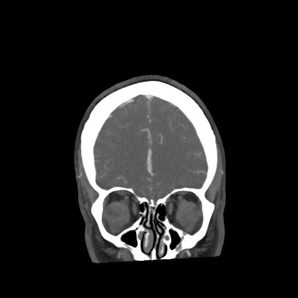 Acute subarachnoid hemorrhage and accessory anterior cerebral artery (Radiopaedia 69231-79009 Coronal C+ arterial phase 20).jpg