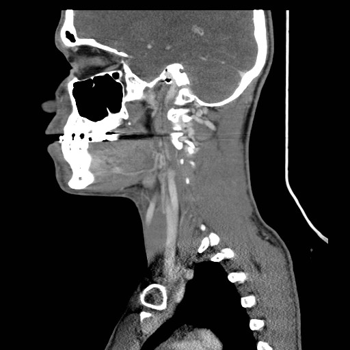 File:Acute submandibular sialadenitis secondary to ductal stone (Radiopaedia 27999-28267 Sagittal C+ delayed 30).jpg