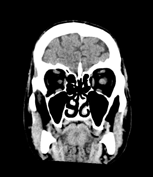 Acute superior cerebellar artery territory infarct (Radiopaedia 84104-99359 Coronal non-contrast 29).jpg
