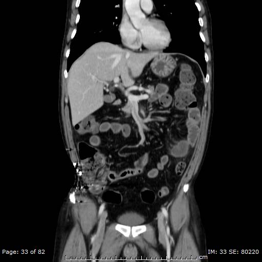 Acute superior mesenteric artery occlusion (Radiopaedia 43636-47060 Coronal C+ portal venous phase 18).jpg