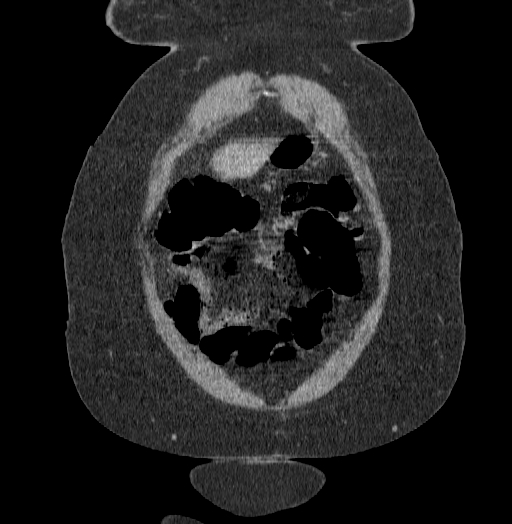 Acute superior mesenteric artery occlusion (Radiopaedia 51288-56960 Coronal C+ portal venous phase 11).jpg